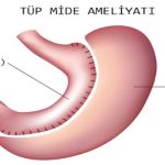 Tüp Mide Ameliyatı Nedir ve Neden Yapılır