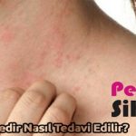 Egzama Nedir Nasıl Tedavi Edilir