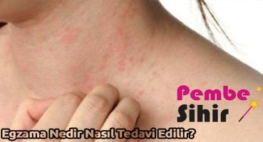 Egzama Nedir Nasıl Tedavi Edilir?