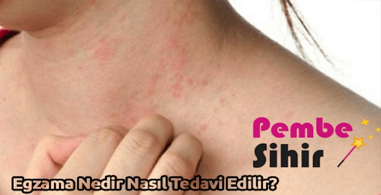 Egzama Nedir Nasıl Tedavi Edilir