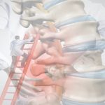 Ameliyatsız Bel Kayması Tedavisi Mümkün mü? Ne Zaman Cerrahi Gerekir?