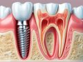 İmplant Diş Tedavisi